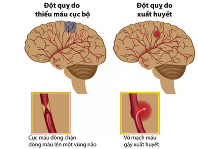 hai loại đột quỵ